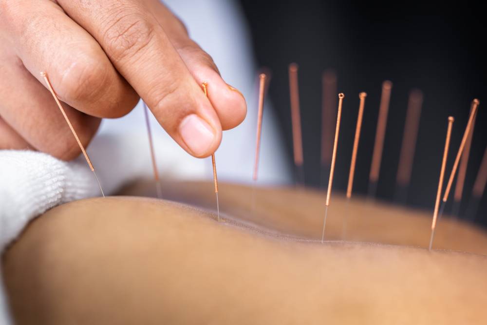 acupuncture chinoise